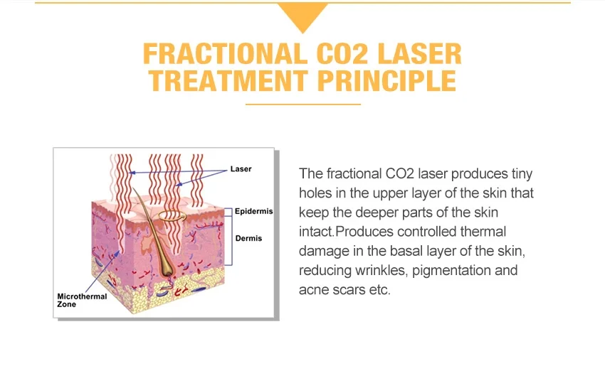 Co2 Laser Skin Tightening Acne Wrinkle Scar Removal Vaginal Tighten Skin Renewing and Resurfacing CO2 Fractional Laser Machine