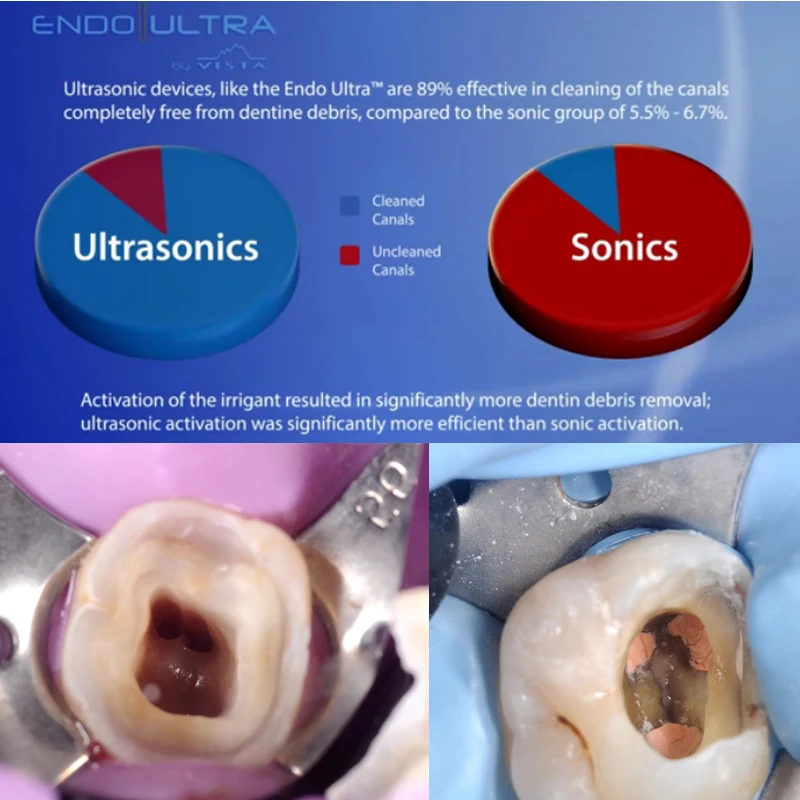 Ultra X Cordless Ultrasonic Dental Irrigator Dentistry Endo File Sonic
