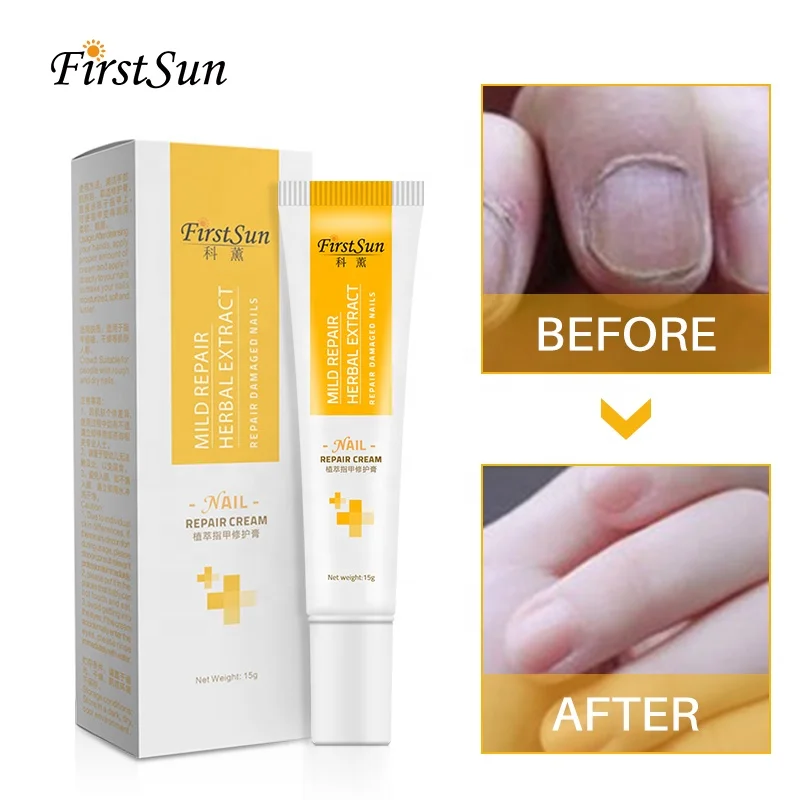 

Effective Herbal Nail Repair Essence Anti Fungal Cream Anti Foot Toenail Fungus Treatment Gel for Finger Feet Nail Care