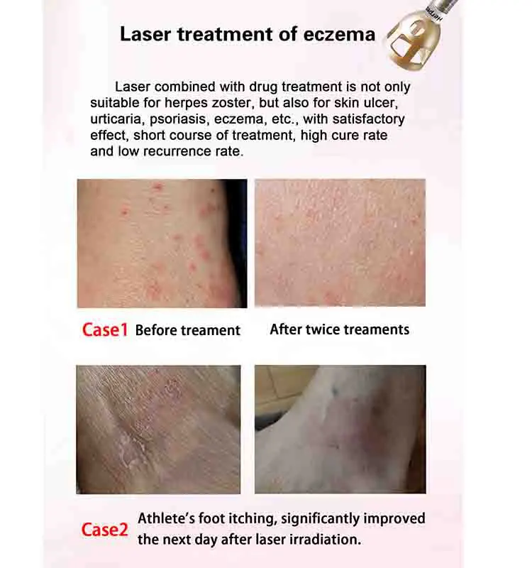 Professional 980nm Diode Laser f Facial Vascular Spider Vein Removal Machine DHL