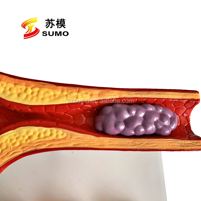 Sumo Heart Atherosclerosis And Thrombosis Model Human Heart Disease Medical Teaching Anatomical Model Buy Pathological Model Of The Blood Vessel 10 X Life Size Medical Teaching Aids Human Thrombosis Model Product On Alibaba Com