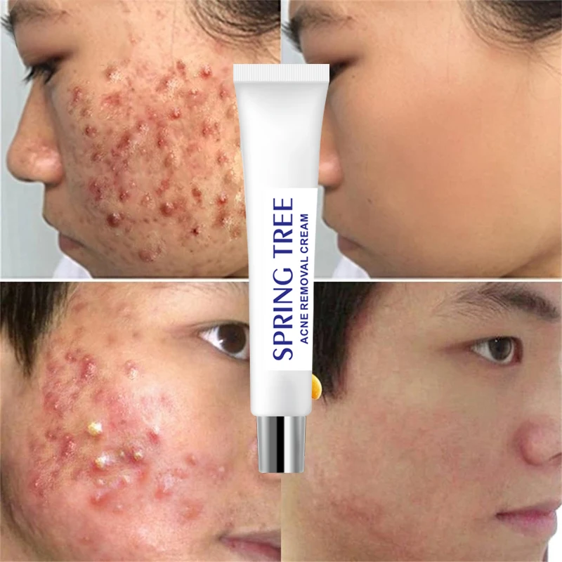 

Spring tree Private label Skin care Acne Treatment Anti Acne Shrink Pores Whitening facial mask acne cream