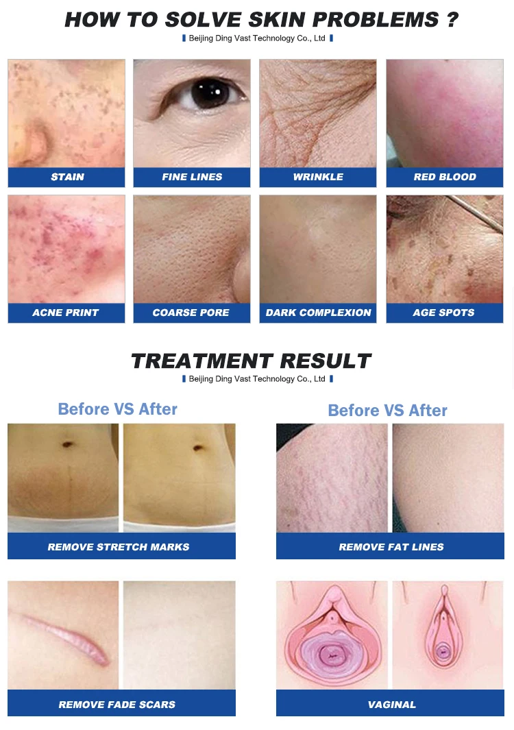 Dingyin Co2 Fractional Laser Parts Fractional Rf Microneedle Machine Thai Beauty Product Therapy Treatment Equipment Arm Medical