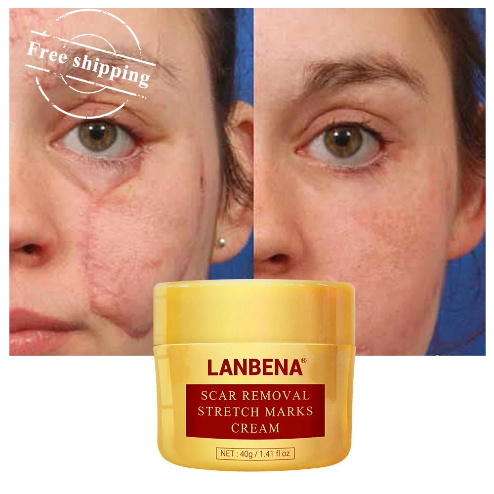 

LANBENA Herbal Acne Scar removal stretch marks cream free shipping