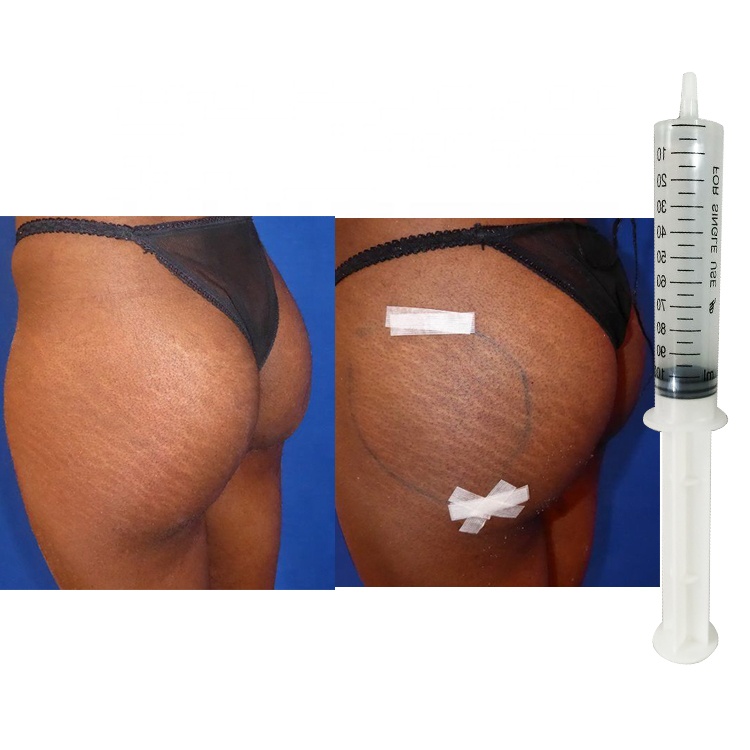 

Wholesale factory 100ml breast filler injection buttocks enlargement HA filler