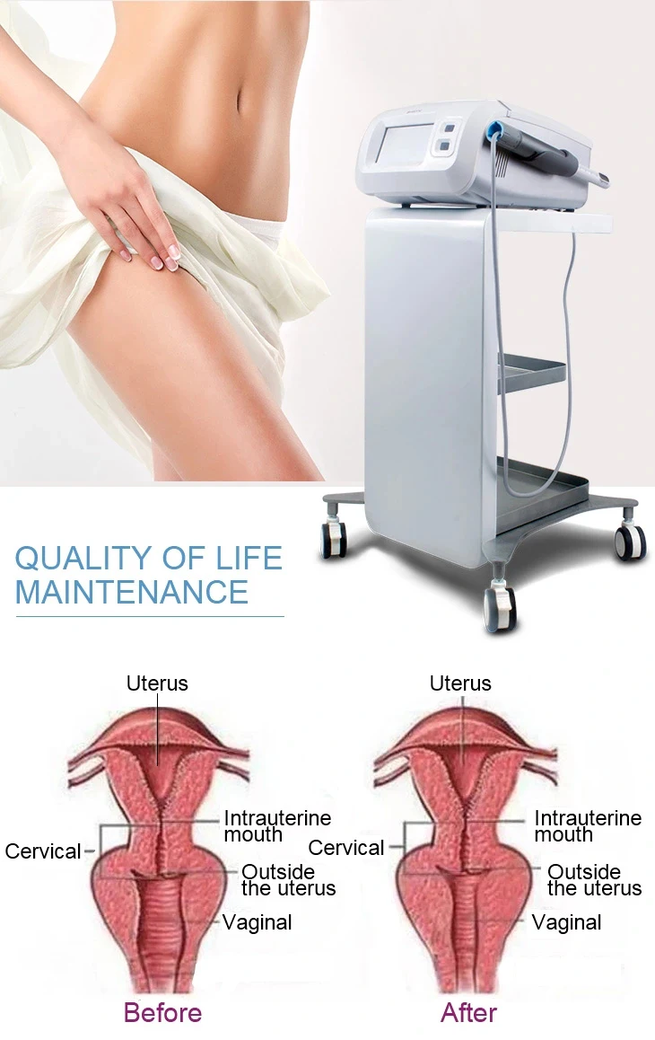 vaginal tightening (6).jpg