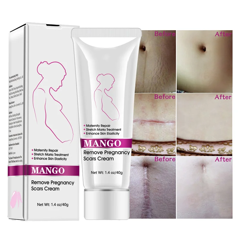 

Mango Pregnancy Mark Treatment Cream Maternity Repair Organic Natural Mild Non-irritating Stretch Marks Removal cream, White