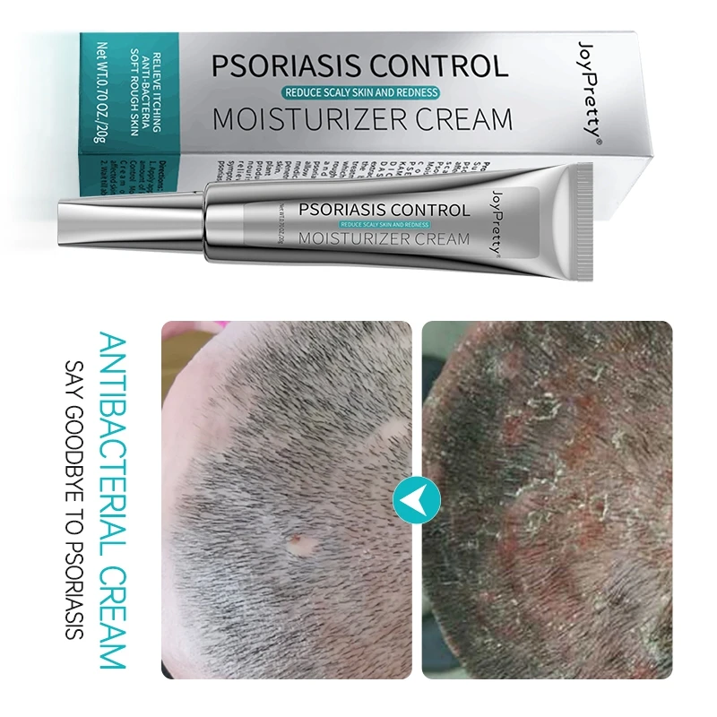 

Skin Care Psoriasis Cream Dermatitis Eczematoid Eczema Ointment Psoriasis Skin Rash Urticaria Desquamation, Beige