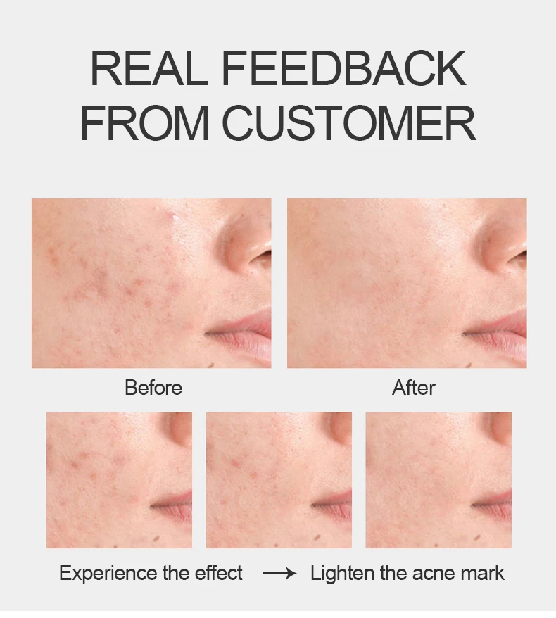 Private Label Salicylic Acid Acne Scar Removal Cream Oil Control Pimple