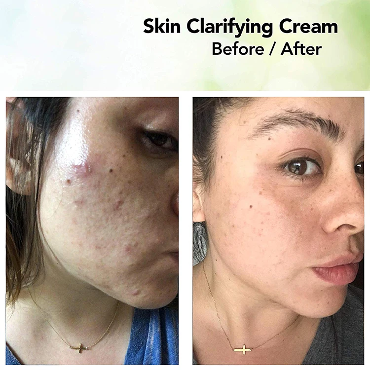 acid for cystic acne