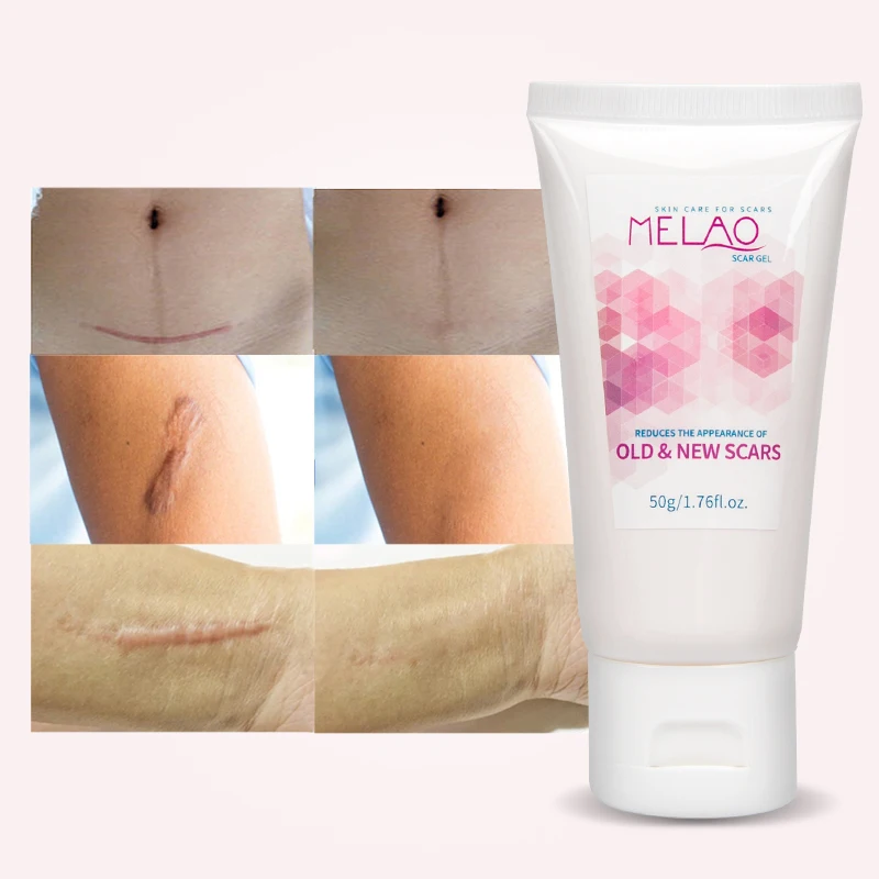 

Best Seller Scar Removal Gel For New and Old Scars Skin Repair Gel for Face Body Stretch Marks Burn Acne, White color