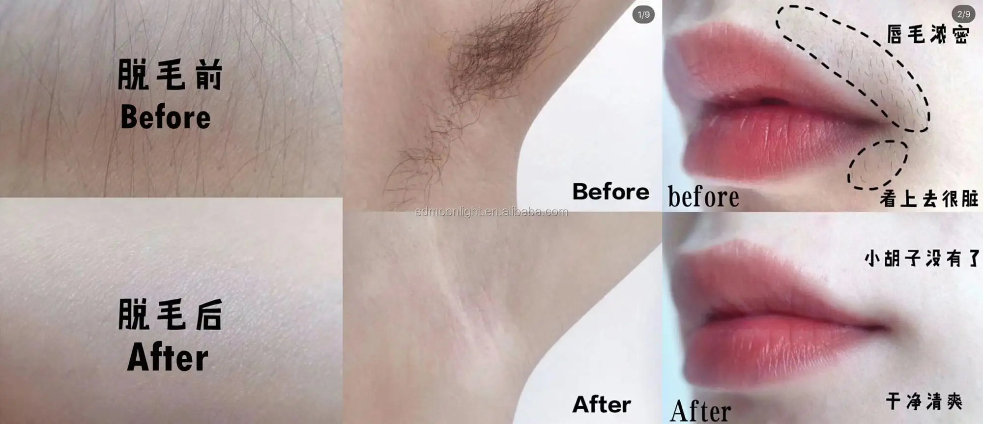 hair removal