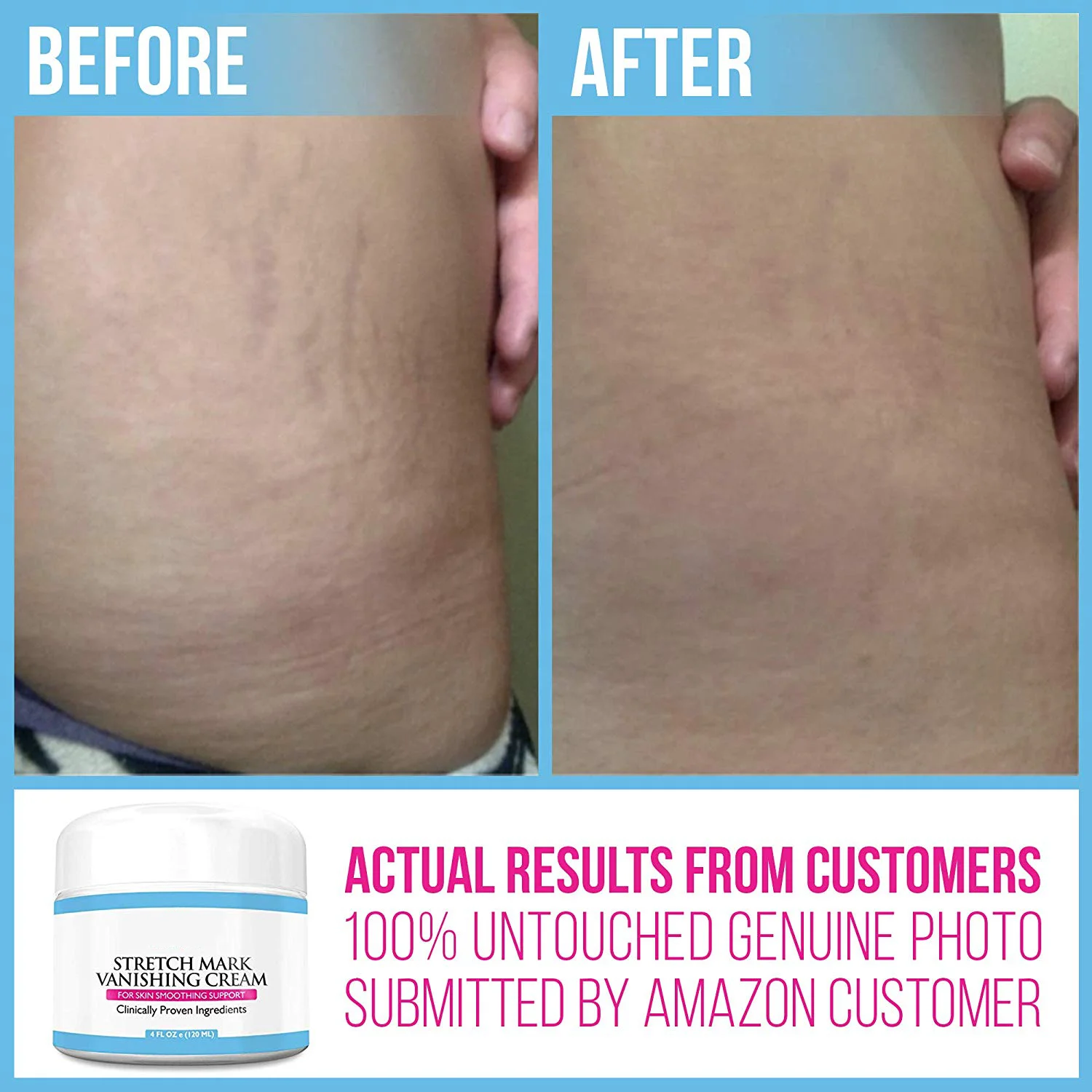 stretch marks cream 1.png