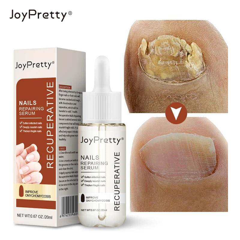 

Anti Fungus Foot Nail Care Treatment Onychomycosis Paronychia Nail Repair Serum Protection Gel Liquid