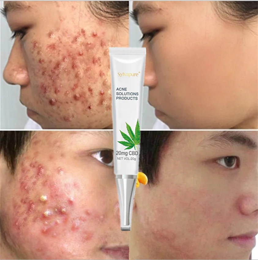 

30g OEM/ODM CBD Hemp Acne Cream removing beverage cream Pimple acne Moisturizer Acne Scar Treatment Face Whitening Cream