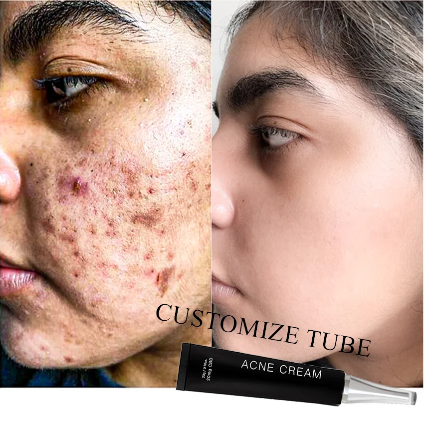 

Acne treatment Scar Remove OEM cosmetic Skin care dark Spot remover hemp lotion acne clearing calming cream for acne-aid