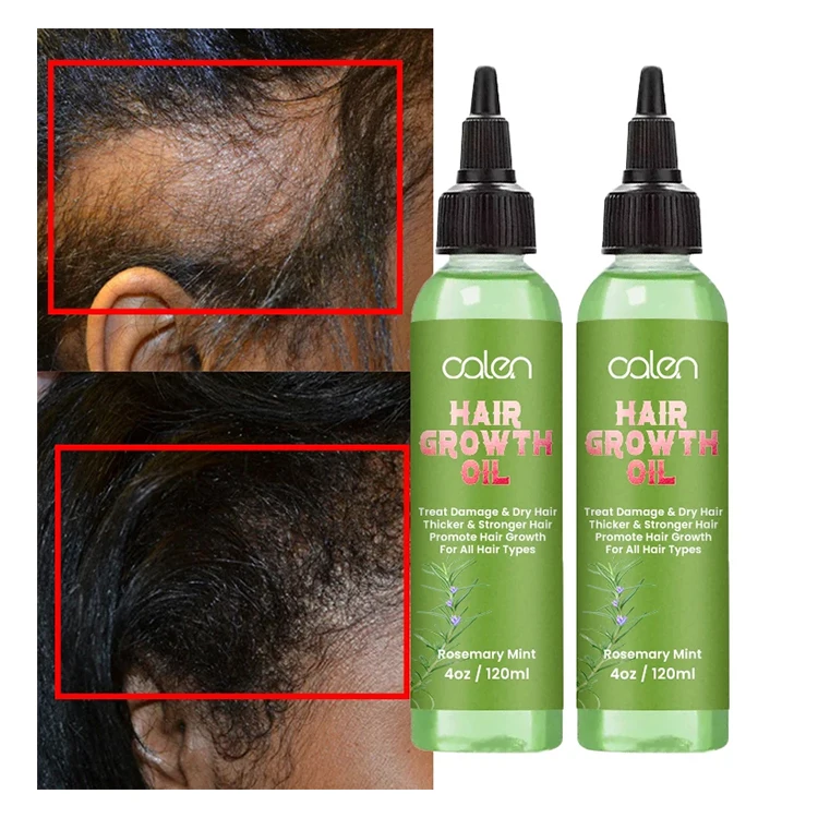 

Oalen Hair Care Improve Hair Growth Nourishing Saver Relieve Tension Refreshing Mint Scalp Hair Oil