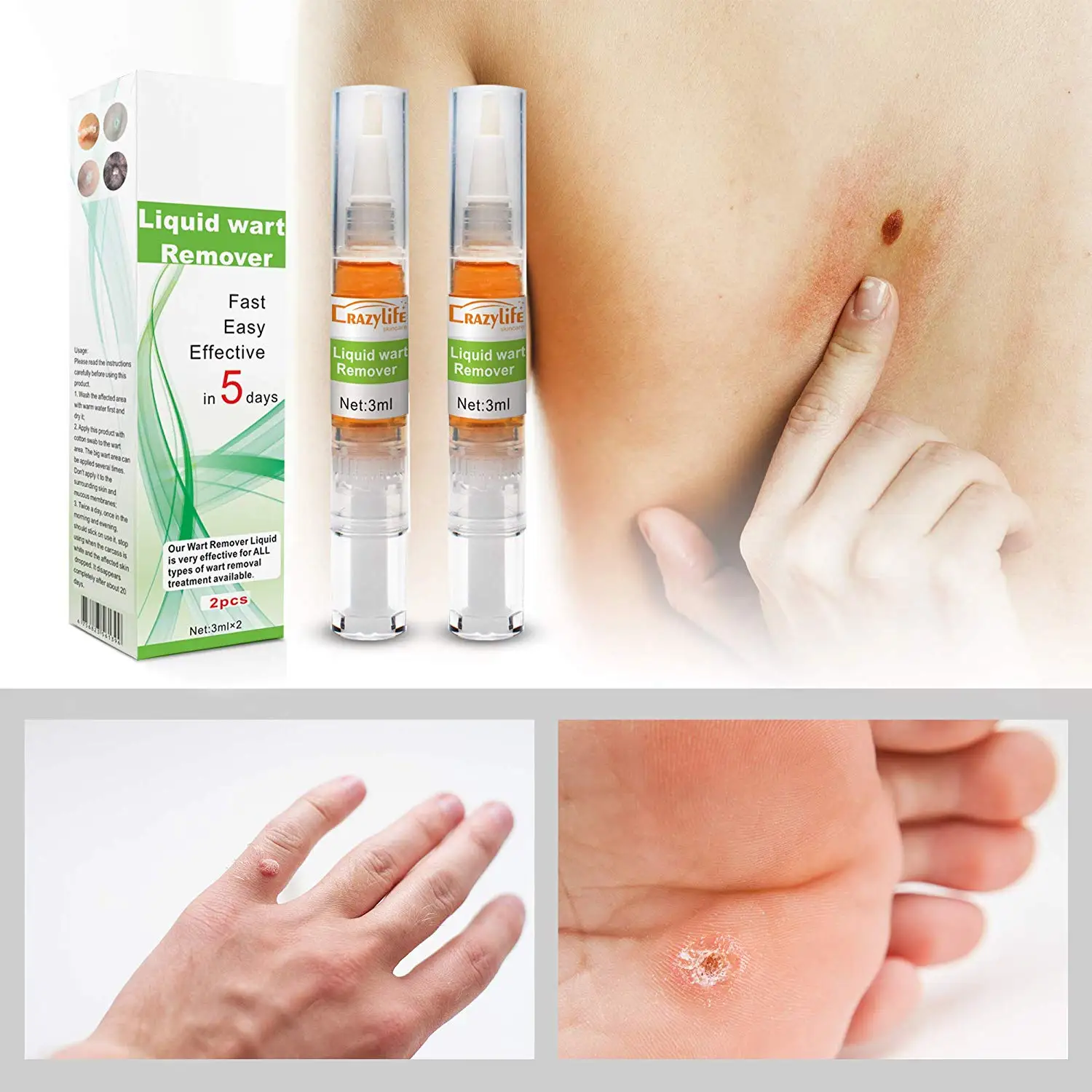 Crazylife Skin Tag Remover Fast Removal Genital Wart Acne Spot Treatment Anti Foot Corn Skin Care Liquid 3ml 2 Buy Skin Tag Remover Skin Care Wart Remover Product On Alibaba Com