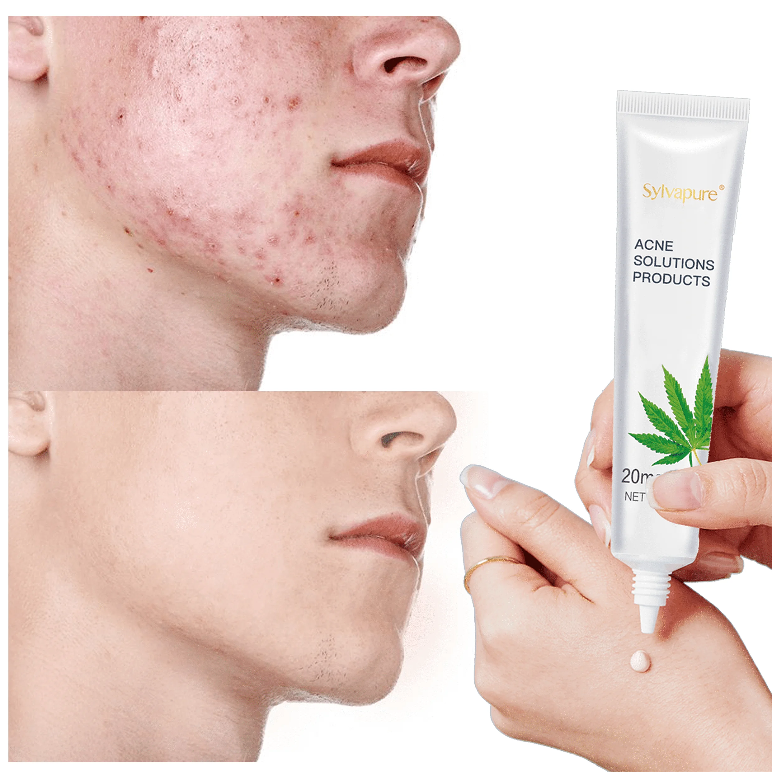 

5/15/30g Acne Treatment Skin Care Remove CBD Hemp Acne Oil Control Oil Shrink Pores Whitening and Moisturizing Cream