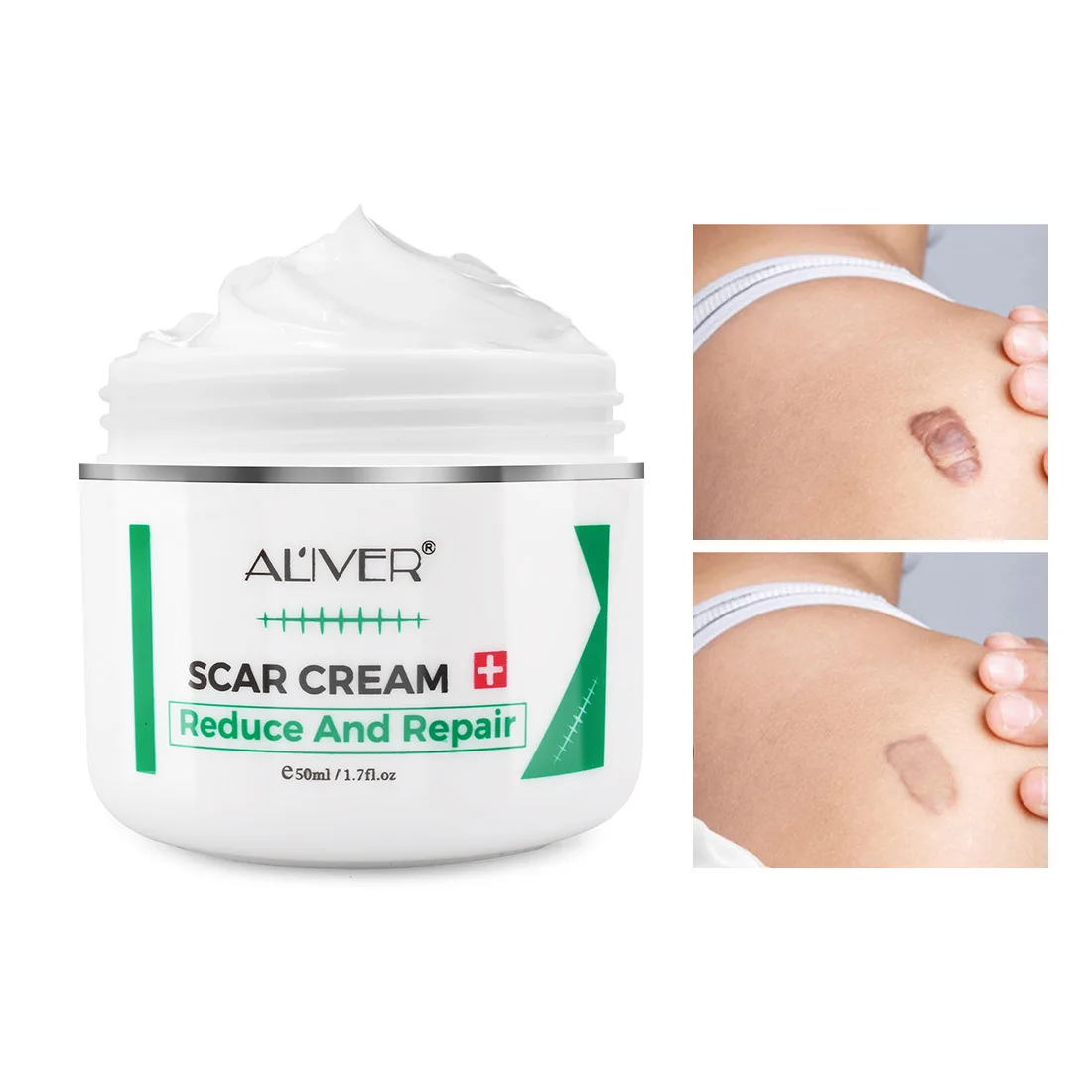 

ALIVER Burn Cesarean Section Scar Convex Surgery Scar Cream Scar Removal Cream