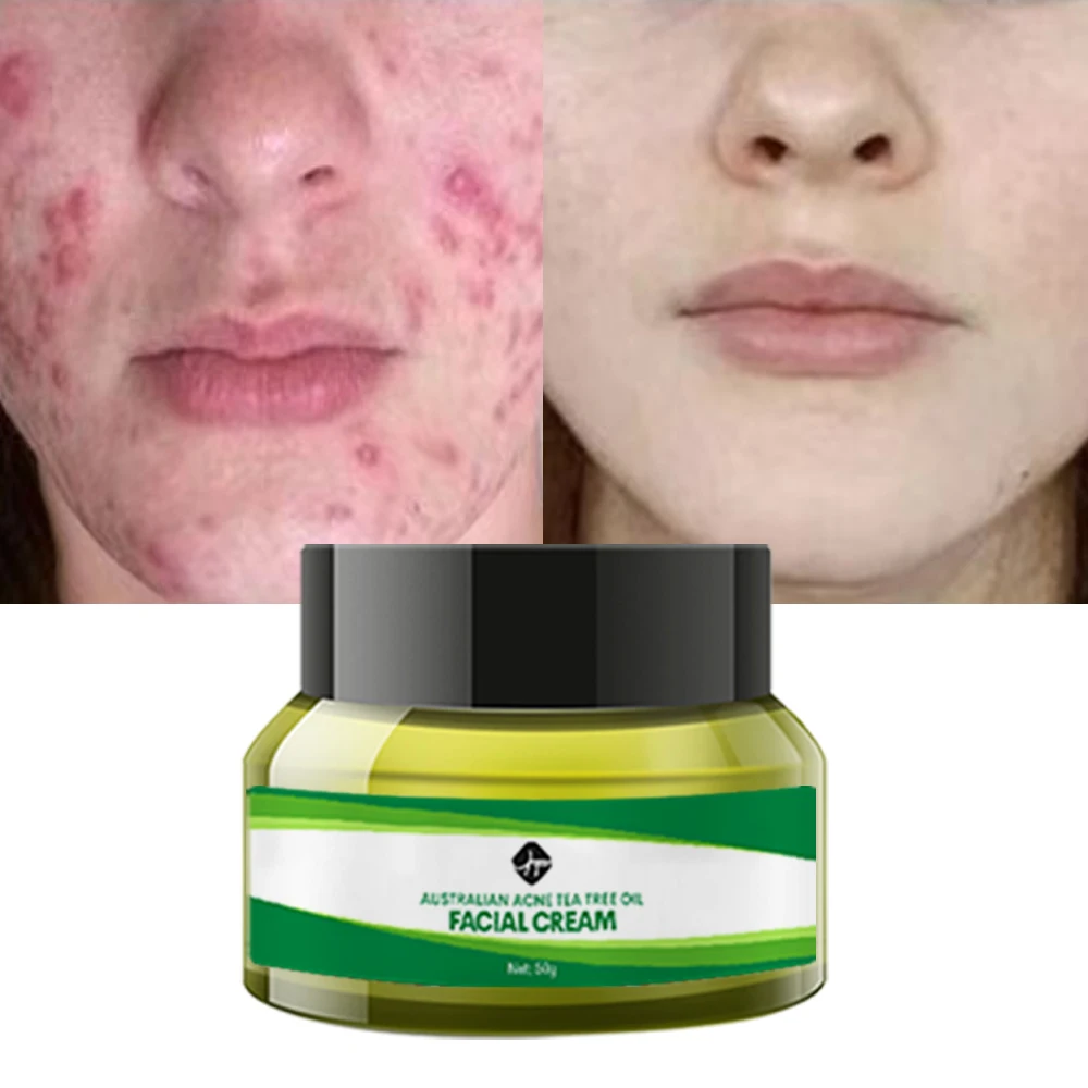 

YF Tea Tree Anti Pimple Acne Treatment Natural Face Cream Lotion Acne Marks Shrinks Pores Removal Facial Skin Care Cream