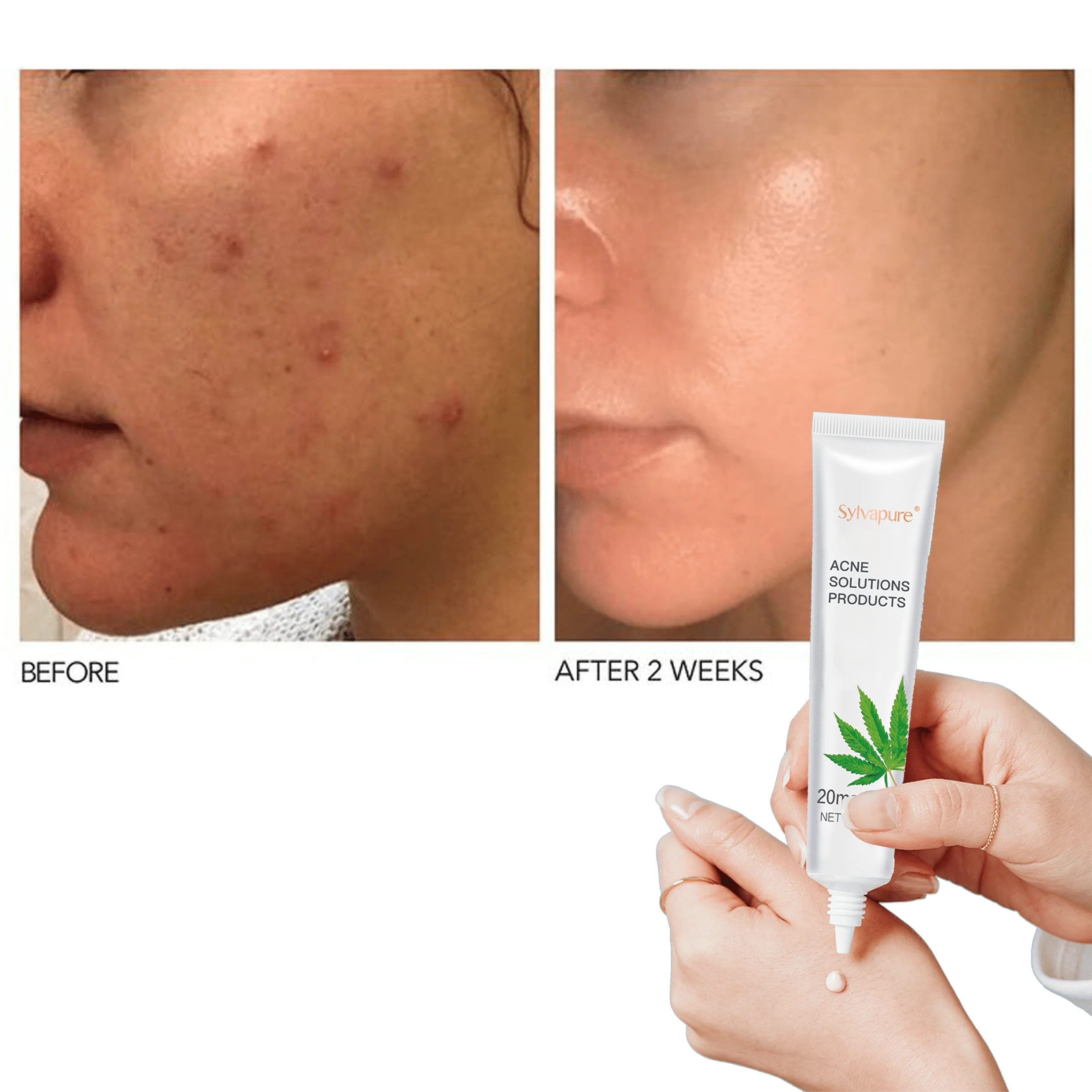 

Best Herbal Anti Acne Scar Treatment Pimples Dark Spot Remover Cream Acne Aid Acne Treatment Cream CBD Skincare Private Label