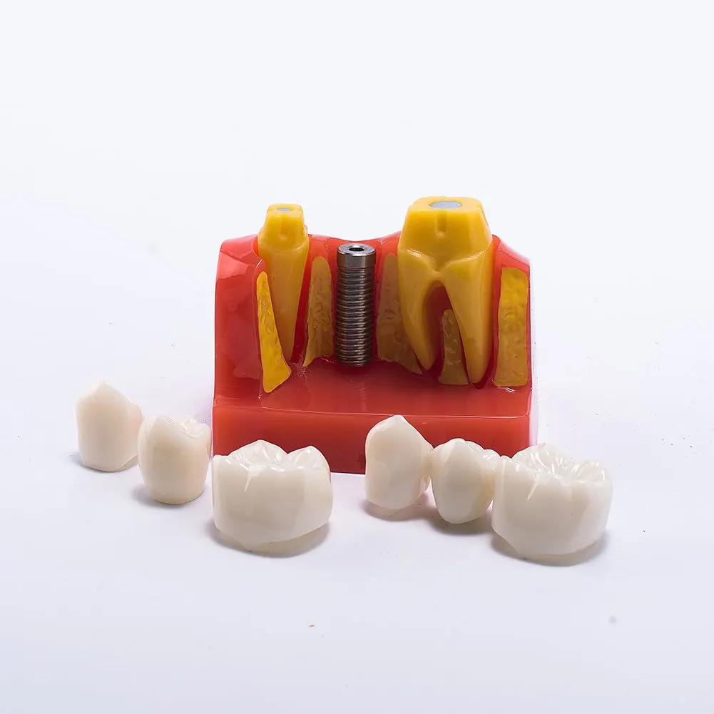 Dental 4 Times Implant Model Teeth Implant Analysis Crown Bridge ...