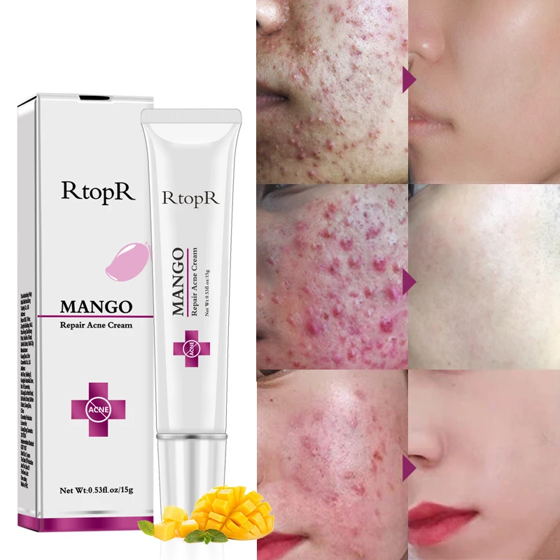 

Remove acne mask nourish skin mildly repair cream 15g
