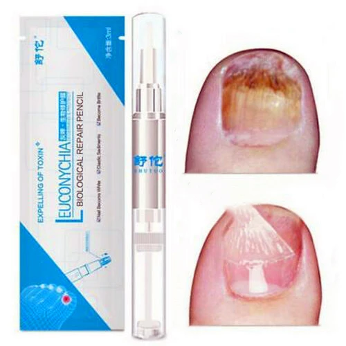 

Anti Fungal Nail Treatment Liquid Toe Nail Finger Fungus Onychomycosis Repair