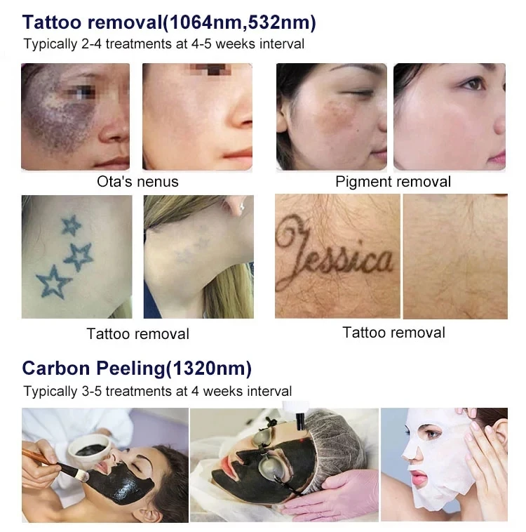 CE approved portable q switch nd yag laser tattoo removal machine