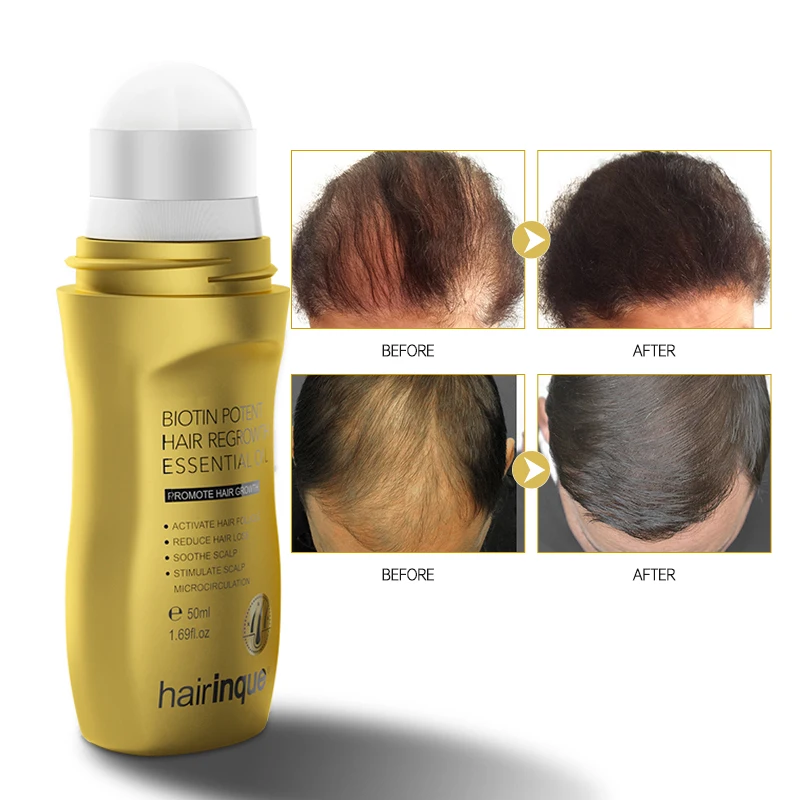 

Women And Men Hair Growth Oil Activate Hair Follicle Biotin Hair Oil Private Label