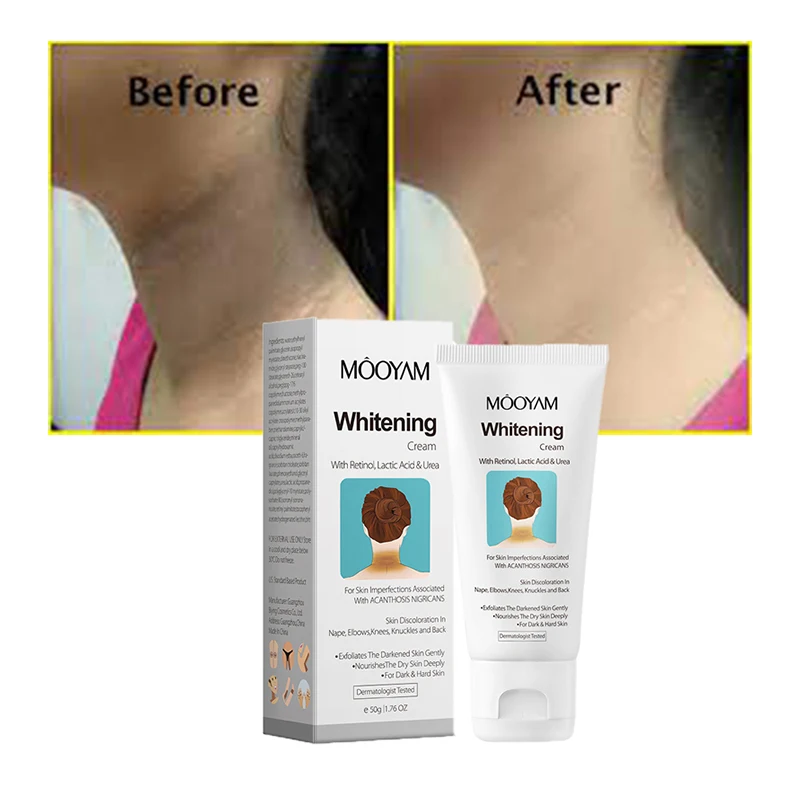 

Acanthosis Nigricans Whitening Cream Dark Spot Corrector Remove Black Patches Knee Elbow Neck Underarm Brightening Cream