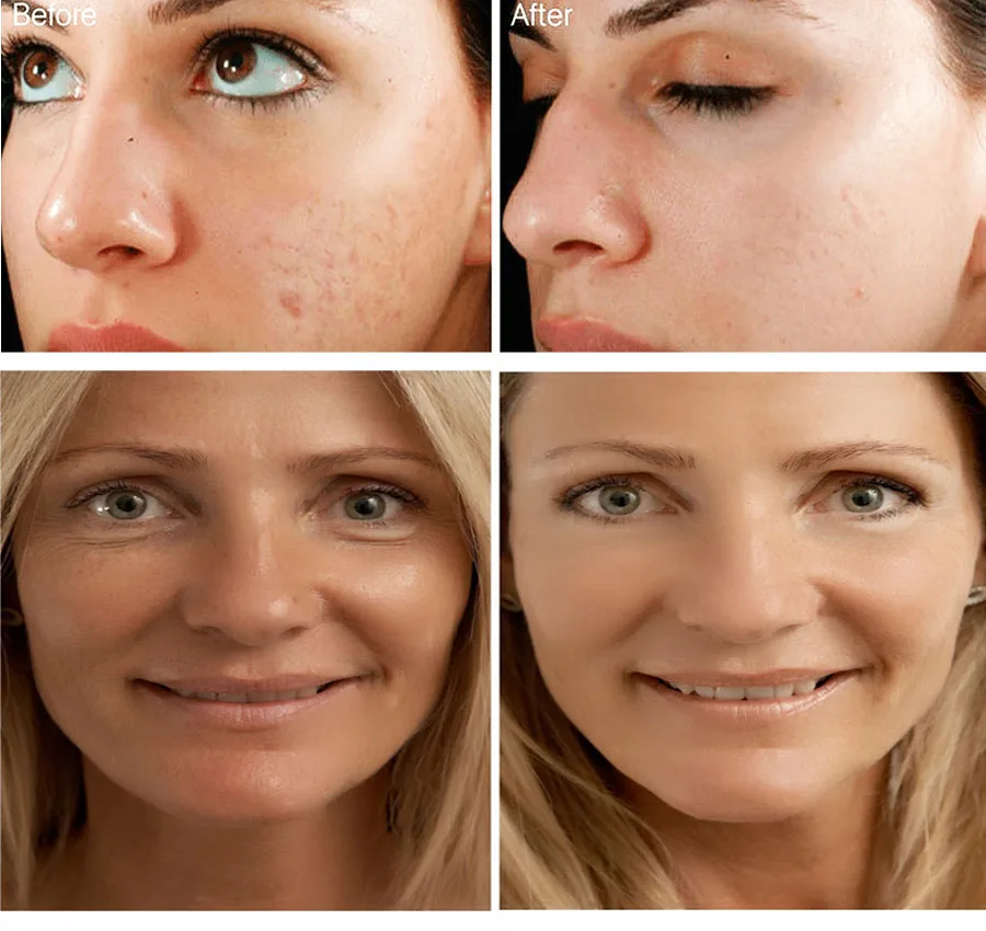 Amoisturizer Liquid HA Mesotherapy Solution Meso Hyaluronic Acid Gel Injection