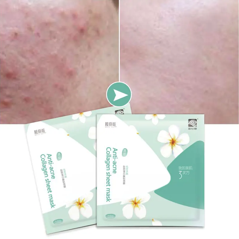 

Anti acne skin green tea face mask collagen sheet facial mask