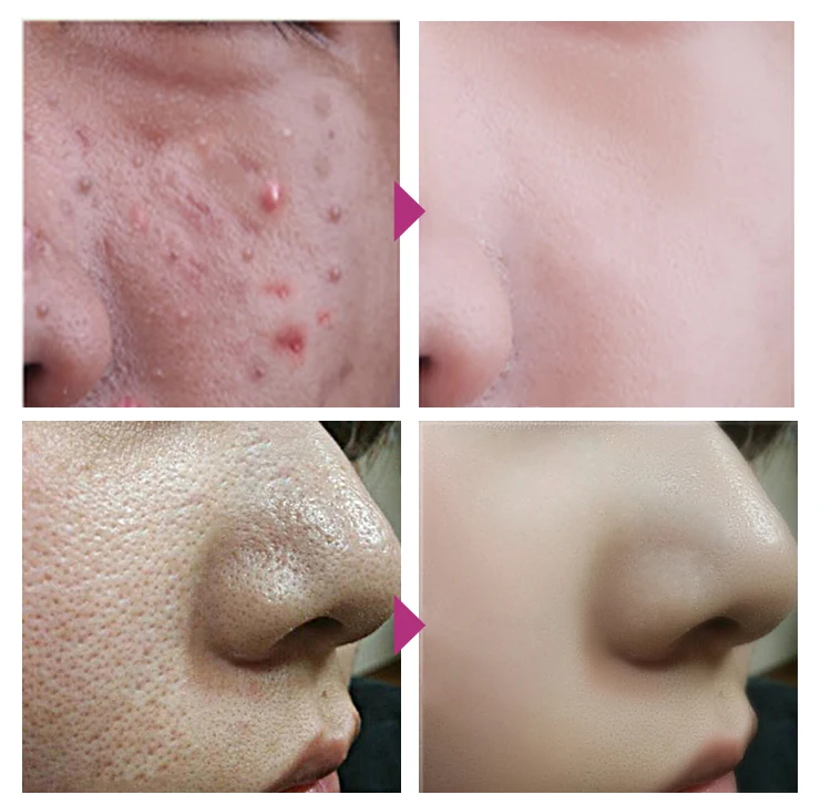 acne lines on face