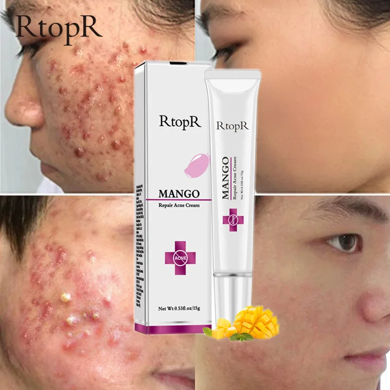

MANGO Acne Treatment Face Cream Blackhead Repair Gel Oil Control Shrink Pores Scar Whitening Moisturizer Skin Care Cosmetics