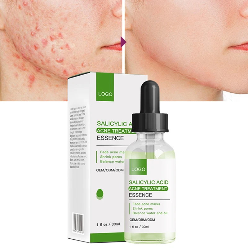

OEM/ODM Facial Skin Care Whitening Anti Acne Reduce Pores Marks Peeling Solution Acne Serum