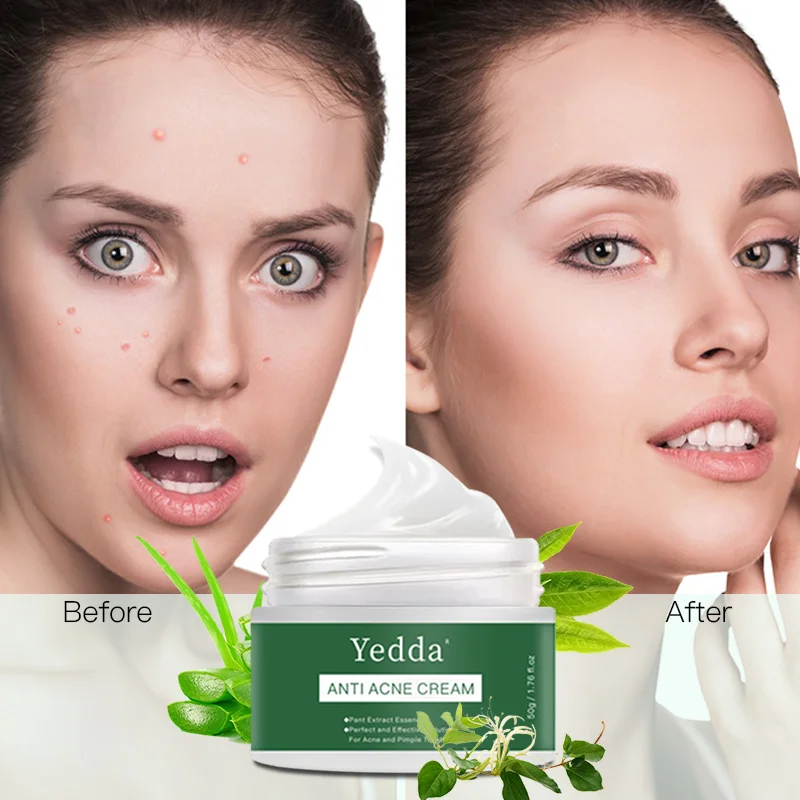 

Private Label Best Organic Herbal Tea Tree Oil Dark Spot Removal Anti Pimple Repair Scar Treatment Acne Face Cream