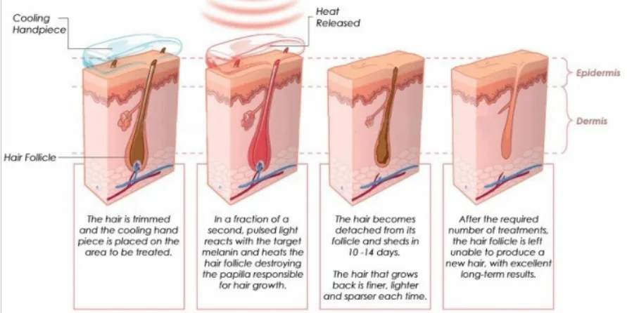 mini 808nm hair removal home use easy to operate, no pain hair removal permanently beijing Anybeauty