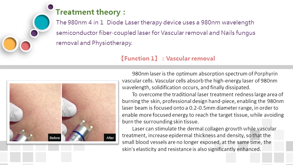 China Factory Seller 980 diode veins laser treatment machine vascular removal