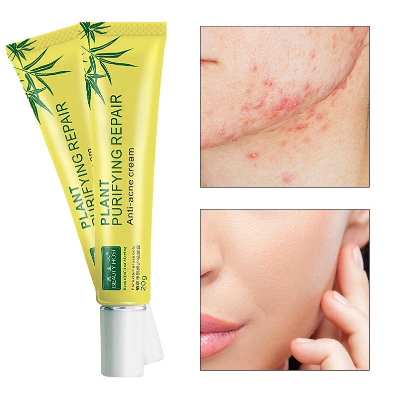

OEM Wholesale Best 20g Pimples Removal Face Acne Treatment Beauty Host Whitening Plant Extract Facial Anti Acne Cream