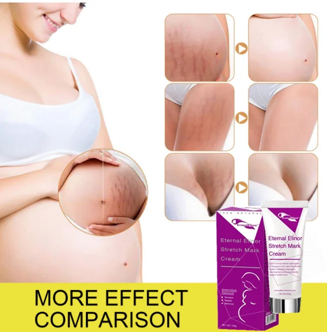 

100% herbal formula Organic Stretch Mark Remove Cream Skin Repair Anti for Pregnancy Repair Scar Marks Stretch Mark Cream