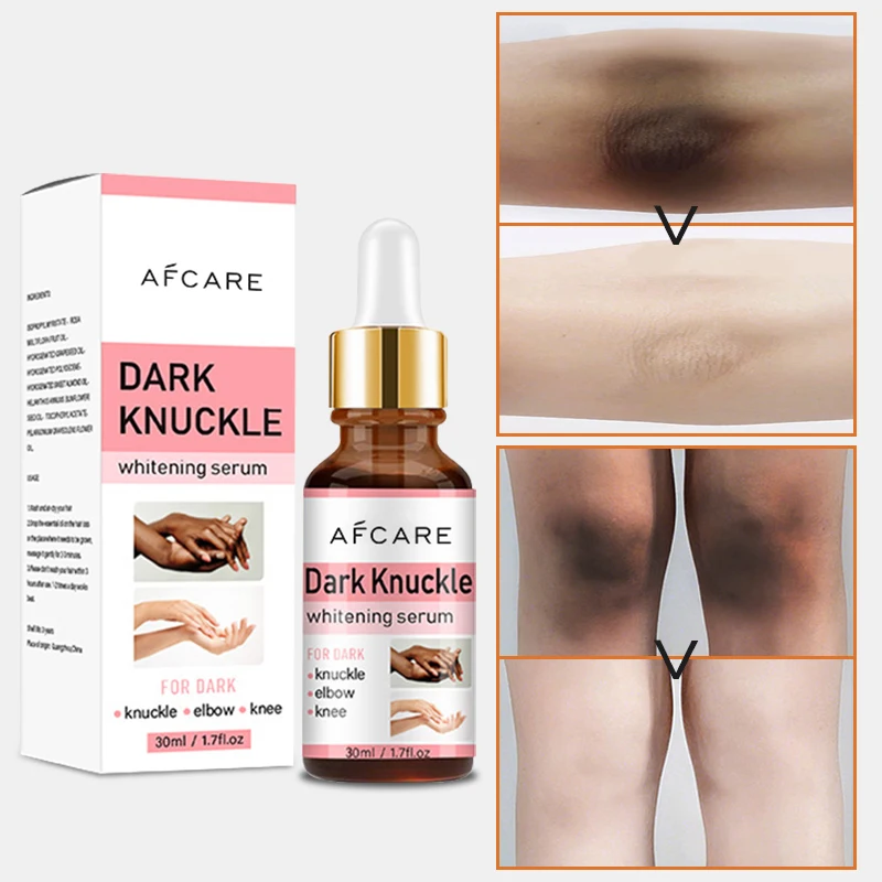 

Private Label Dark Knuckles Fast Whitening Body Serum Hand Knuckle Elbows Knee Intense Stains Remover Serum