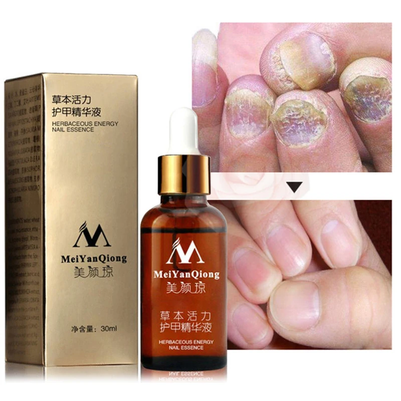 

Fungal Nail Treatment Feet Care Essence Nail Foot Whitening Toe Nail Fungus Removal Gel Anti Infection Paronychia Onychomycosis, Brown