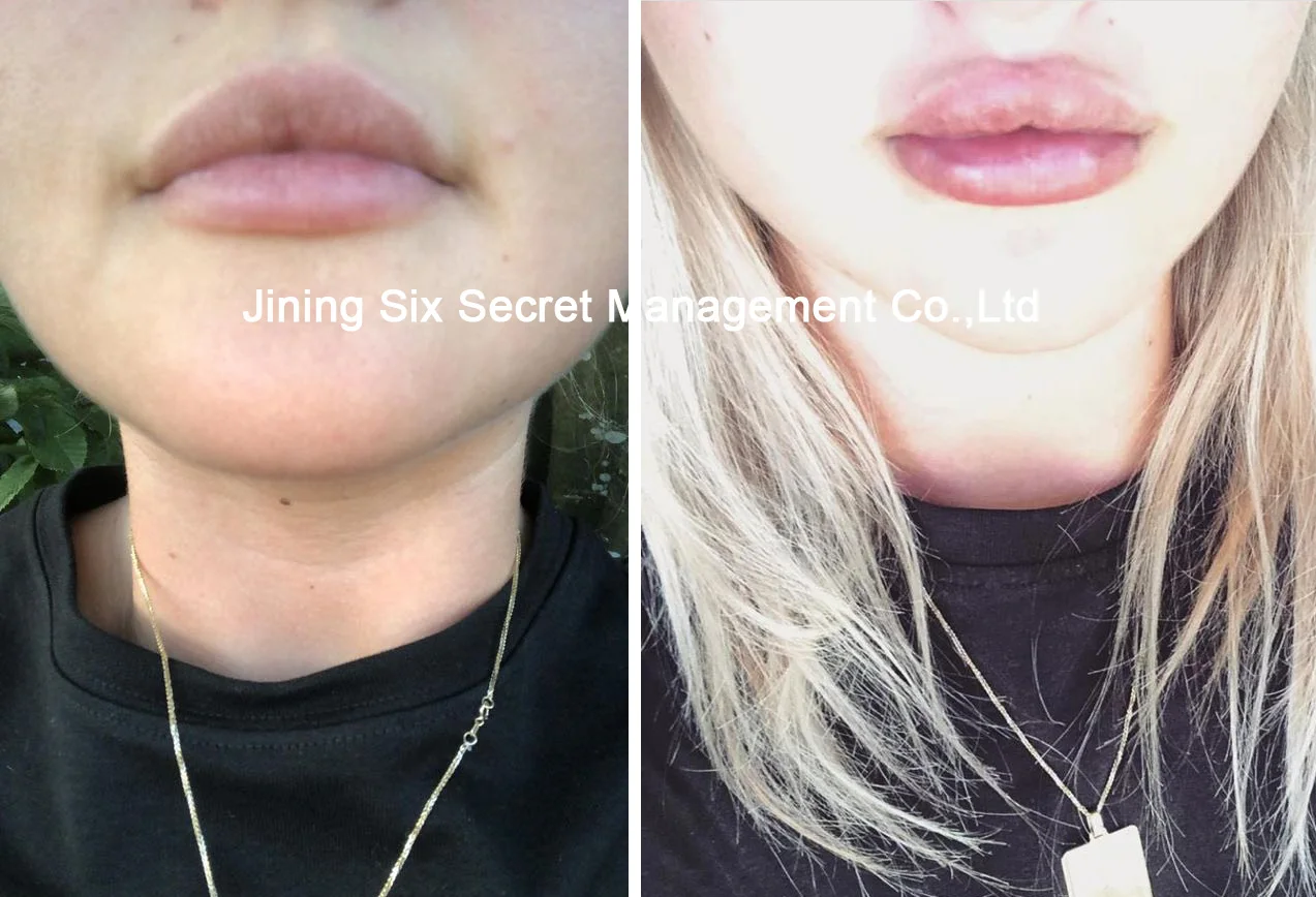 No Needle Air Pressure Injector Hyaluronic Acid Pen for Lips Filling.jpg