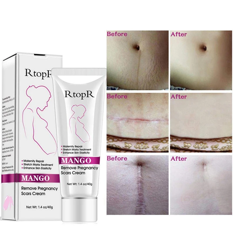 stretch marks cream (2).jpg