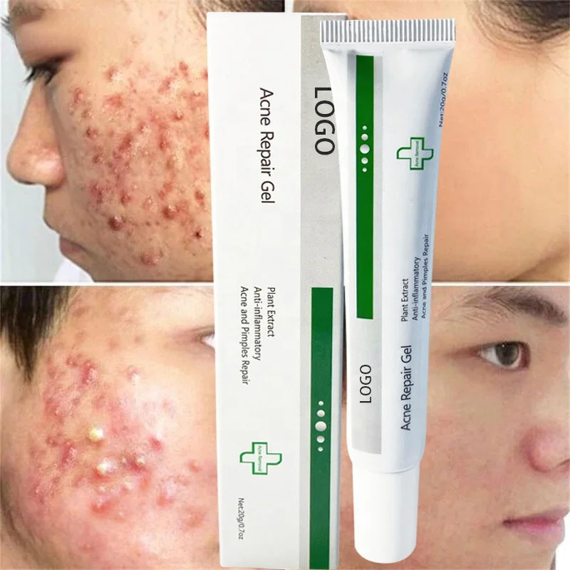 

Private Label Organic Acne spot treatment Gel Scar Repair Gel For Face Oil-Free Maximum