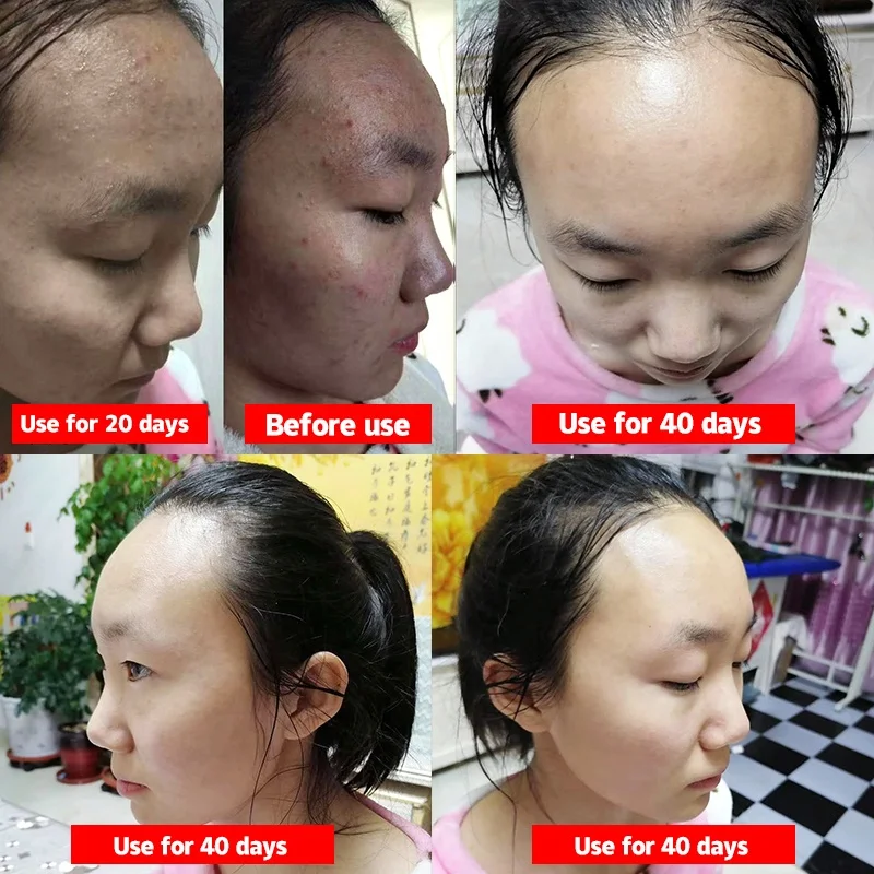 
OEM/ODM private label customized Chinese herbaceous plant Acne treatment remove medicine powder/glay skin care facial mask 