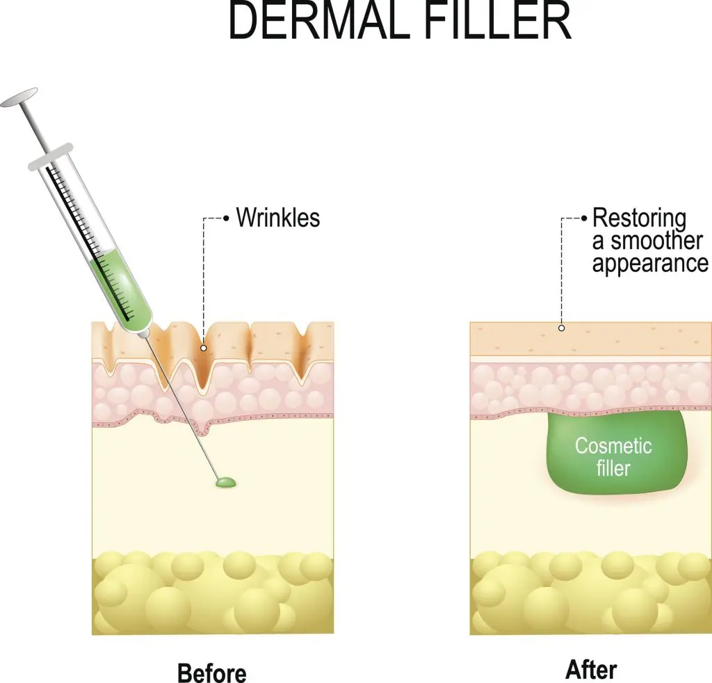 dermal-fillers-