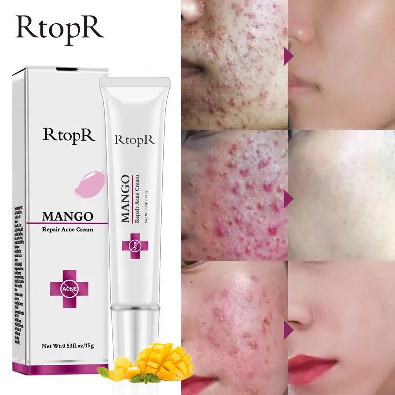 

15g best Skin Repair removal shrink pores scar acne cream